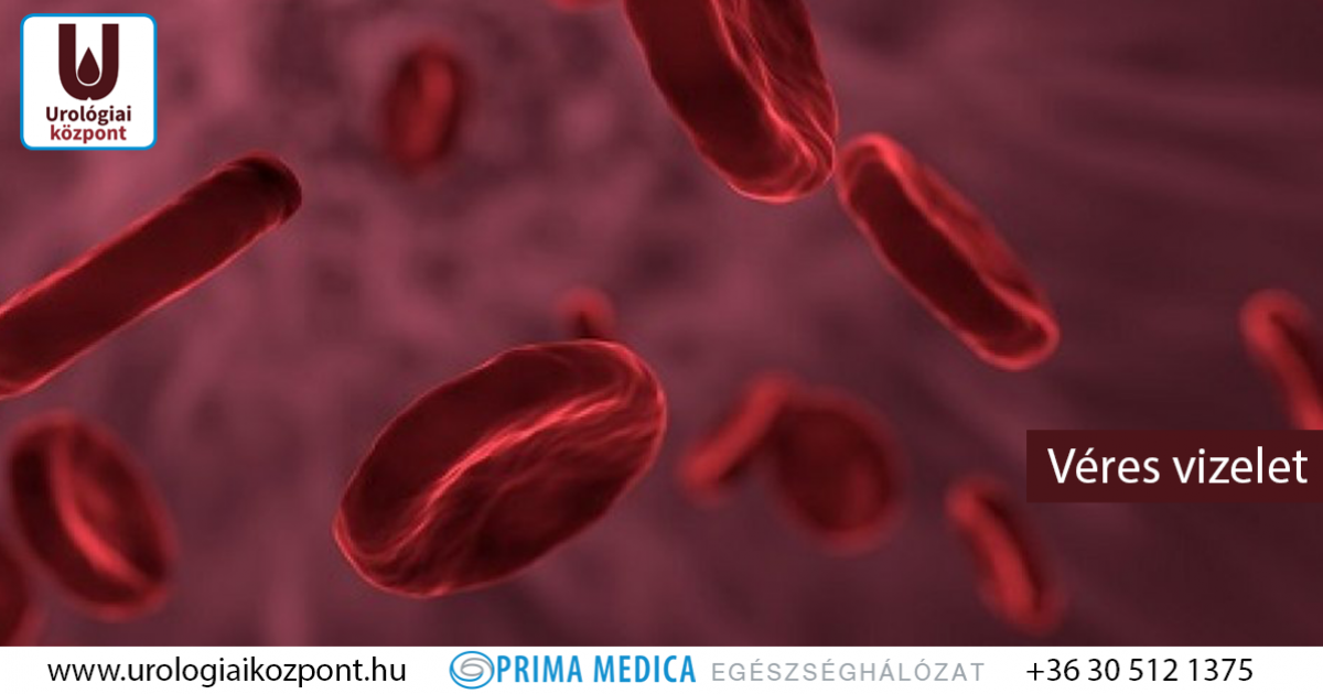 prostatitis vizelet vérrel a férfiaknál isup grade 2