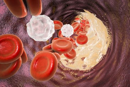 A merevedési zavar a magas koleszterinszint miatt is kialakulhat.